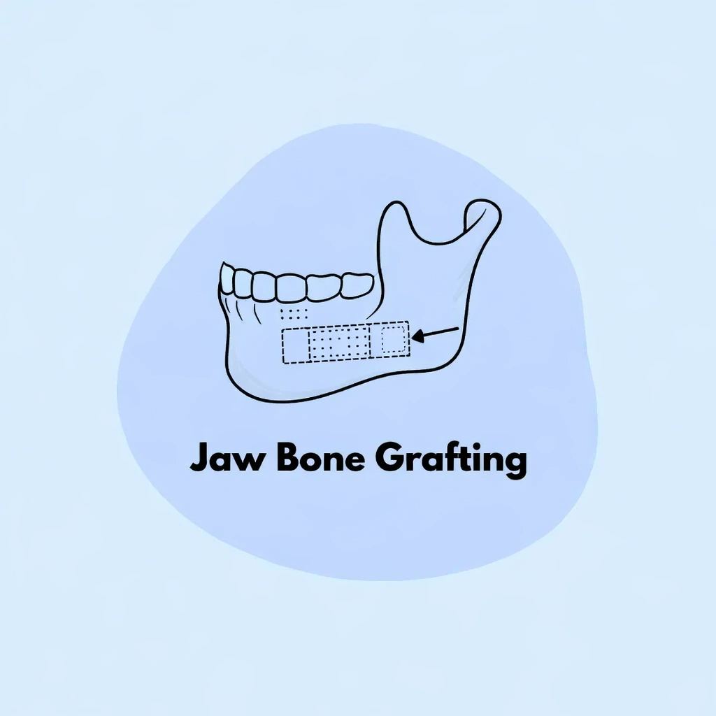 Jaw Bone Grafting